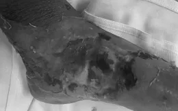 Nhiễm trùng nặng vì tự ý đắp thuốc sau khi bị rắn cắn