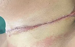 Cứu sống bệnh nhân bị dây thép cứa cổ trong tai nạn hy hữu