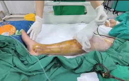 Nguy kịch tính mạng vì nhiễm trùng nặng sau vết xước nhỏ ở chân