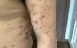 Cảnh giác với tổn thương da dai dẳng