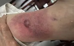 Vết thương nhỏ khi tắm biển - cảnh giác nhiễm trùng hoại tử chết người