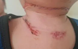 Cảnh báo nguy cơ bỏng điện từ ổ cắm với trẻ nhỏ