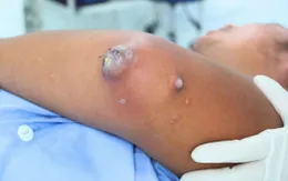 Gout gây hoại tử khuỷu tay ở tuổi 31: Bệnh đang trẻ hóa nguy hiểm