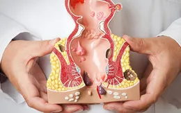Nguyên nhân và cách phòng ngừa bệnh trĩ