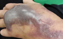 Chủ quan với vết thương hở, cụ ông 74 tuổi sốc nhiễm khuẩn do tụ cầu vàng