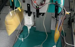 Cứu sống người bệnh viêm tụy cấp hoại tử do rối loạn mỡ máu và lạm dụng rượu