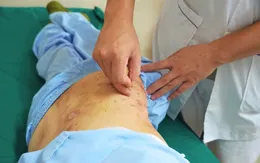 Zona thần kinh: Từ tổn thương da đến biến chứng nguy hiểm