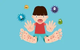 Trẻ quay lại trường học, cha mẹ lưu ý phòng ngừa bệnh tay chân miệng