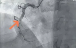 Nhồi máu cơ tim trẻ hóa: Người 30 tuổi cũng có thể gục ngã bất ngờ