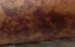 Ăn thịt lợn chưa nấu chín kỹ, nam bệnh nhân nhiễm liên cầu lợn nguy kịch