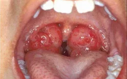 Cẩn trọng khi trẻ bị viêm amidan, VA tái phát nhiều lần