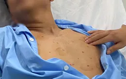 Cảnh báo hiểm họa từ thói quen chích lể, giác hơi tại nhà