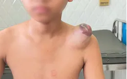 Loại bỏ thành công u ác tính mô mềm hiếm gặp ở bé 11 tuổi