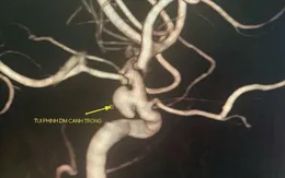 Gỡ "bom nổ chậm" trong não cho cô gái 33 tuổi