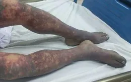 Liên cầu lợn - Sát thủ từ bàn ăn, cảnh báo nguy cơ tử vong