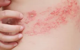 Hà Nội: Gia tăng bệnh da liễu ở trẻ em