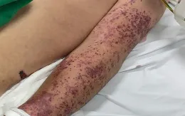 Mắc liên cầu lợn sau nhiều lần ăn lòng lợn, nem chua