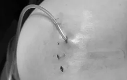 Tiêm filler: Làm đẹp nhanh hay cái giá sức khỏe phải trả?