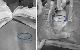Phối hợp liên viện cứu sống bệnh nhân bị vết thương tim nguy kịch