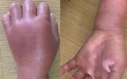 Cảnh báo: Ong đốt có thể nguy hiểm tính mạng