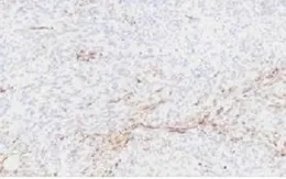 Đau bụng âm ỉ 2 tháng, phát hiện u mô đệm đường tiêu hóa nguy cơ cao