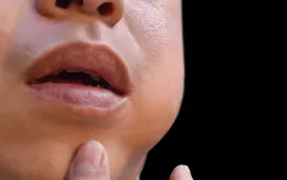 Bài học từ ca bệnh quai bị và cảnh báo của bác sĩ