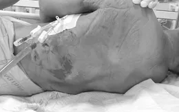 Cụ bà nguy kịch sau khi tiêm thuốc giảm đau vùng cổ