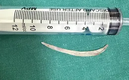 Liên tiếp cứu sống 2 ca dị vật đường tiêu hóa hiếm gặp