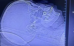 Người thợ xây bị đầu vít bắn xuyên má, rạn xương gò má