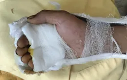 Phẫu thuật nối gân, phục hồi bàn tay cho bé trai bị dao cứa đứt 4 ngón