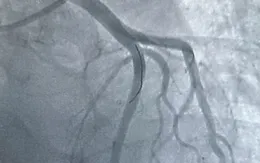 Cứu sống nhiều ca nhồi máu cơ tim nhờ can thiệp kịp thời