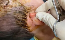 Bé 19 tháng tuổi bị chó dữ cắn vào vùng nguy hiểm