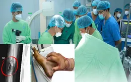 Kỳ tích ghép tạm tay đứt lìa vào chân cứu thai phụ: Bàn tay được bảo tồn tốt
