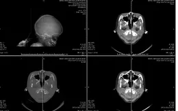 Kích hoạt báo động đỏ cứu sống bé 6 tuổi chấn thương sọ não nặng