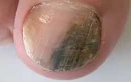 Ung thư hắc tố ở móng: Hiểm họa từ những vệt đen bất thường
