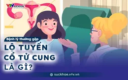 Lộ tuyến cổ tử cung là gì
