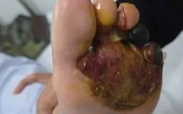 Đừng để "bàn chân đái tháo đường" trở thành thảm họa vì nhiệt