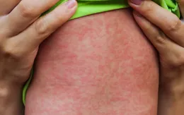 Canada báo cáo ca tử vong đầu tiên liên quan đến dịch sởi