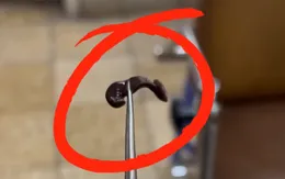 Bé trai 4 tuổi nhập viện vì vắt ký sinh trong mũi