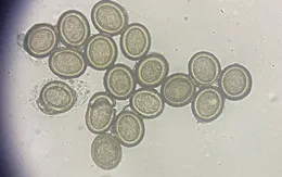 Nhiễm sán dây - cảnh báo nguy cơ từ thói quen ăn sống