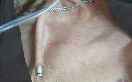 Nguy cơ tử vong tức thì khi tự cắt catheter