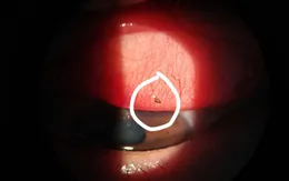 Dị vật kết mạc - Đừng xem nhẹ những "vết xước nhỏ"