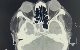 Viêm xoang bướm - Căn bệnh ít gặp nhưng tiềm ẩn nguy cơ tử vong