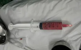 Cảnh báo biến chứng nặng sau khi tiêm chất làm đầy không rõ nguồn gốc