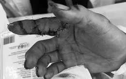 Hồi sinh ngón tay đứt lìa nhờ kỹ thuật vi phẫu hiện đại