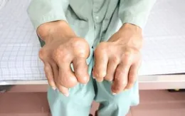 Tự điều trị gout, bị biến chứng nặng