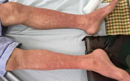 Sốt xuất huyết Dengue nặng gia tăng, nhiều ca sốc nguy kịch