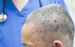 Thoát chết sau khi bị ong vò vẽ đốt 117 nốt