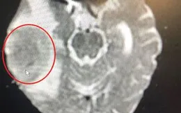 Đau đầu, chóng mặt xin đừng chủ quan