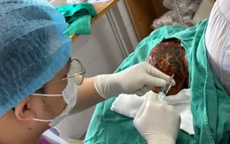 Tin vào "đắp lá" chữa zona, cụ ông 88 tuổi loét rộng vùng đầu